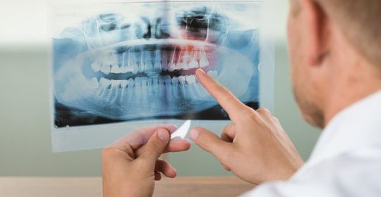 Okluzja w stomatologii – przyczyny, objawy, leczenie