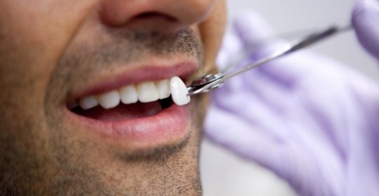 Przedłużanie zębów – sposobem na piękny uśmiech
